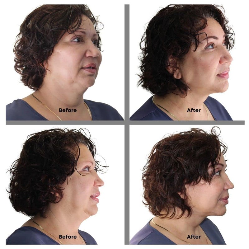 Bring It Up Instant Neck Lift Tape 30 Day Supply, Transparent Neck Lifting Anti Wrinkle Stickers - Tones Sagging Necklines Instantly - Made in USA - Image 2